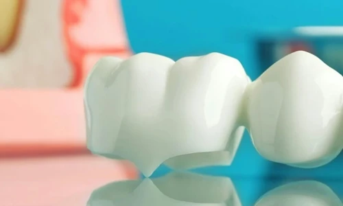 ¿Qué son los puentes dentales?