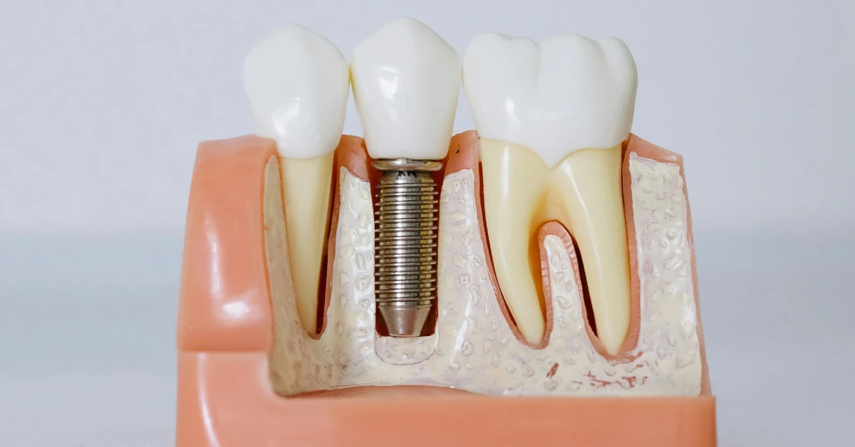 ¿Cuál es la vida útil de un implante dental?