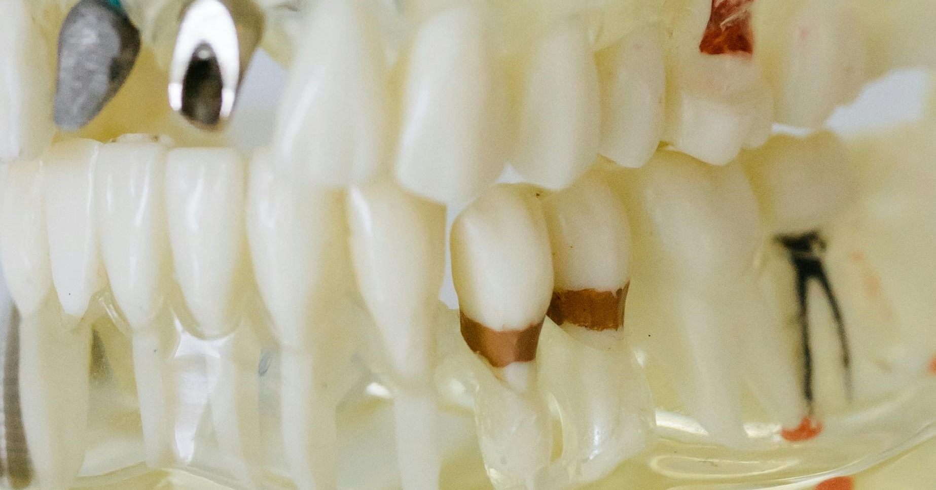 Materiales de coronas dentales