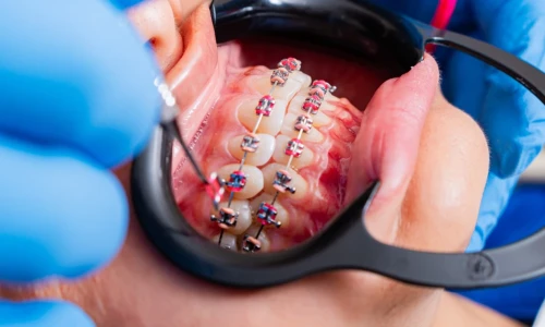 ¿Hay riesgos en usar brackets de adulto?