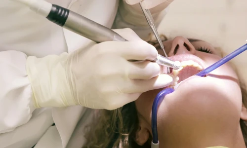 ¿Qué es una limpieza profunda dental?