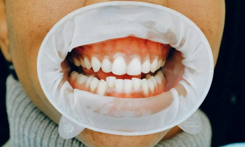 Problemas comunes en las encías