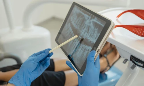 ¿Cuándo puedo ponerme un implante después de un root canal?