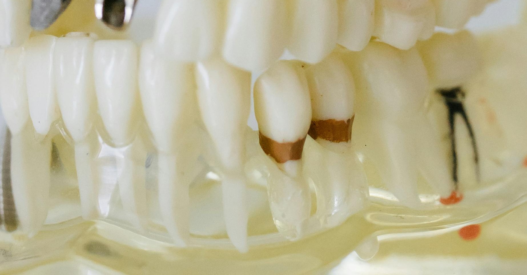 Tipos de implantes