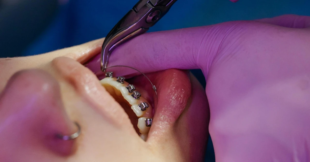 ¿Cuánto tiempo debo usar brackets?