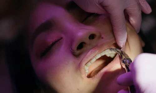 ¿Puedo perder un diente por caries?