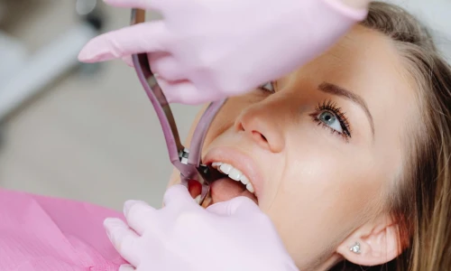 ¿Cuándo se necesita una extracción dental?