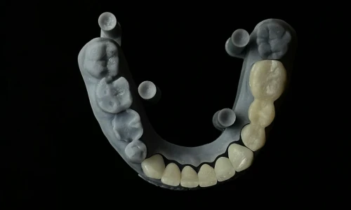 How Many Teeth Does a Dental Bridge Cover?