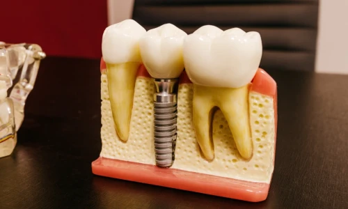 ¿Cuáles son las partes de un implante dental?