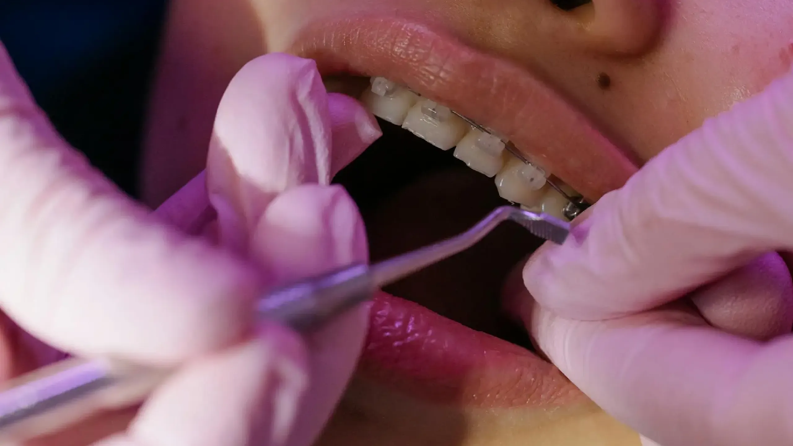 ¿Qué es un puente dental?