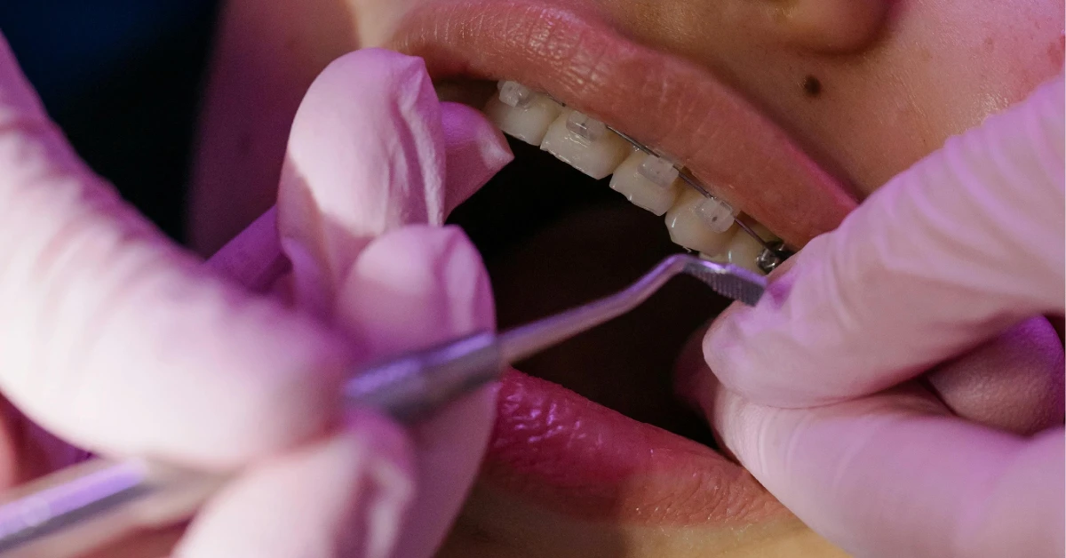 What Is a Dental Bridge?