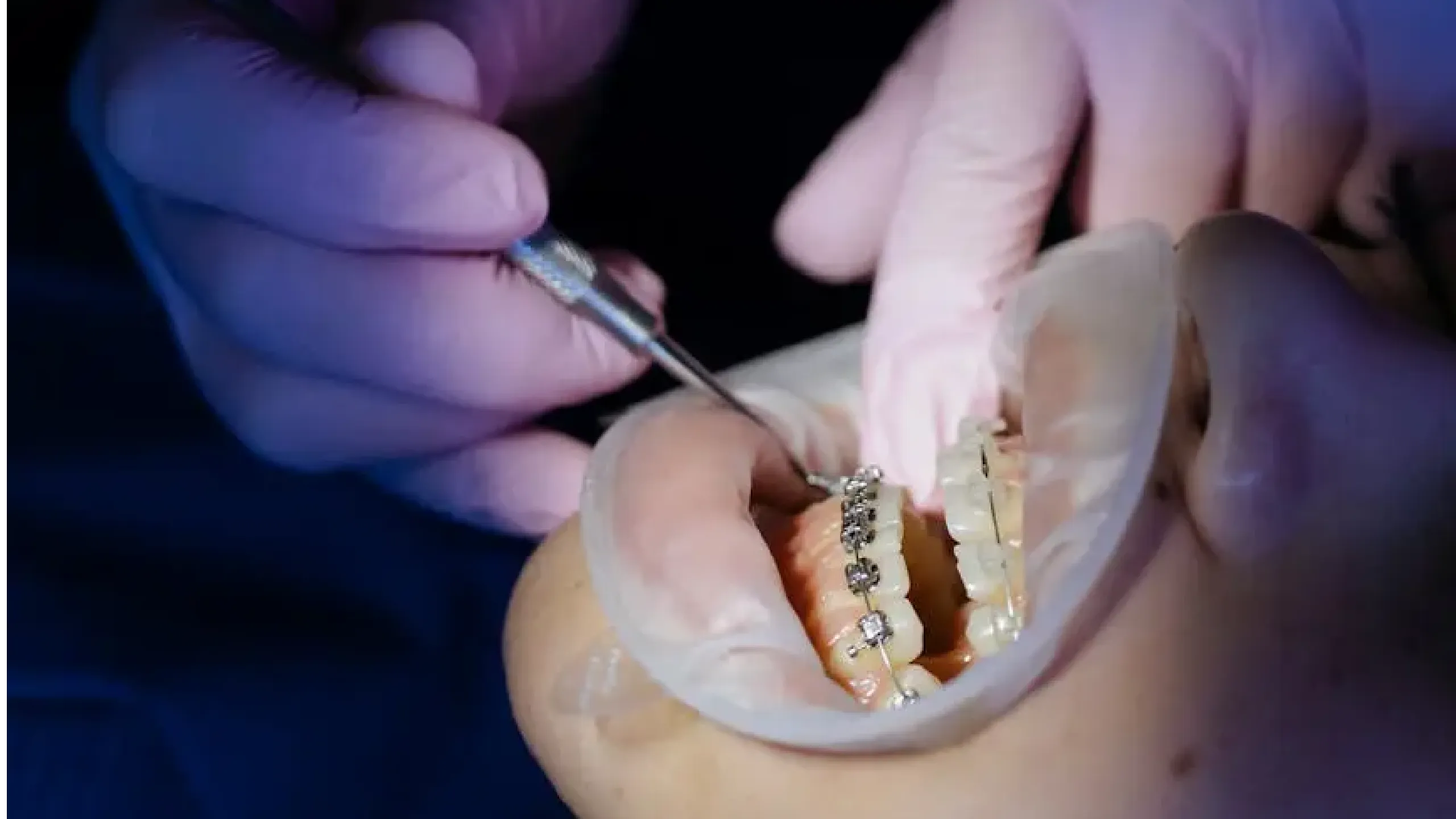 ¿Cuándo debería usar brackets?
