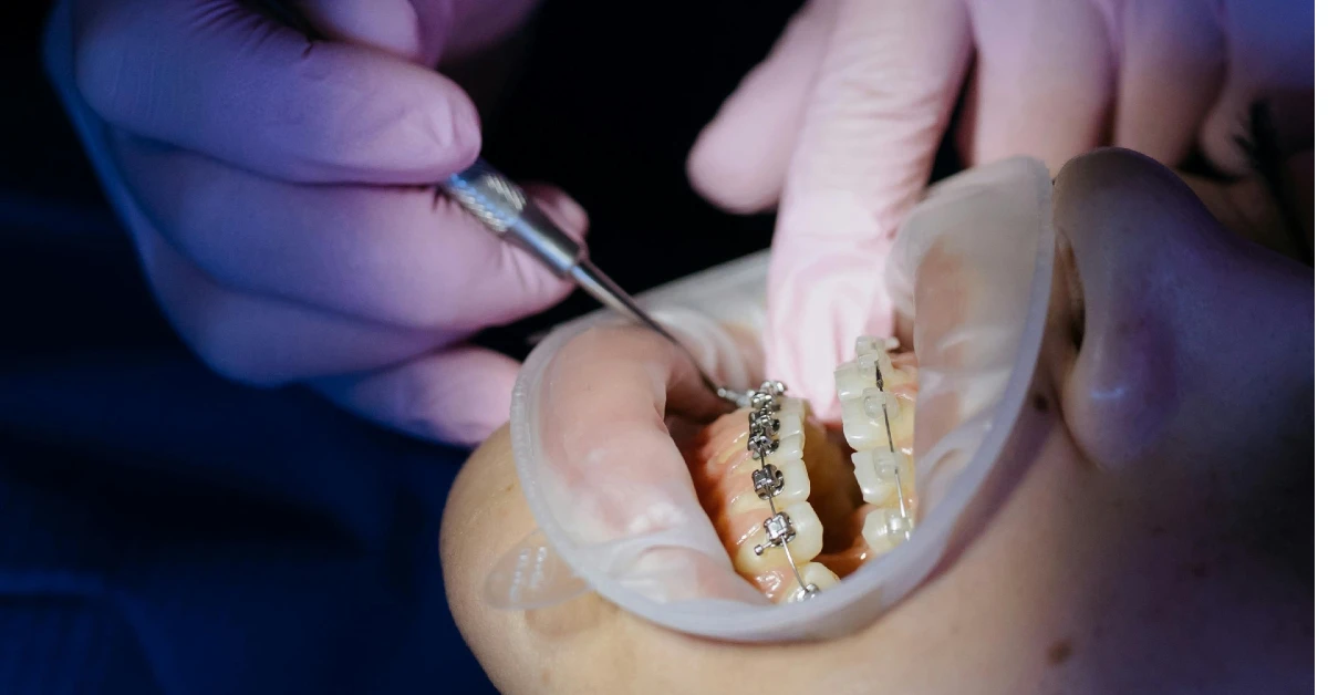 When Should I Use Braces?