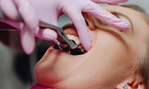 ¿Qué hacer después de que se me rompe un diente?