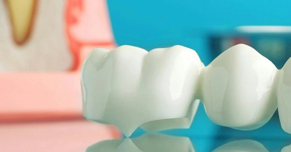 ¿Qué son los puentes dentales y cuándo se necesitan?