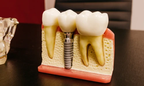 Cuánto toma para que un implante dental pueda tener corona