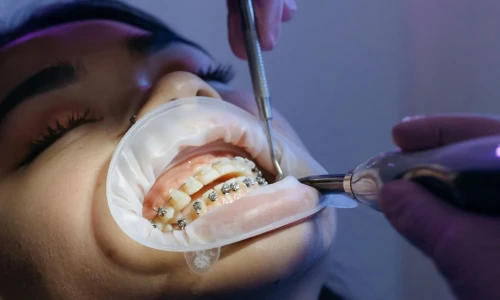 Cuándo se necesita una endodoncia