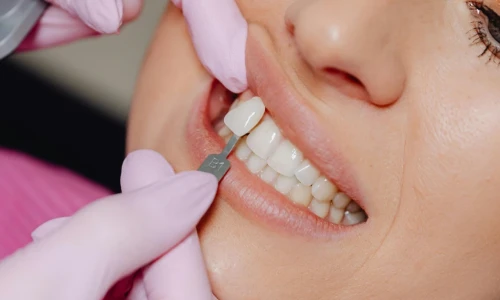 ¿Cuánto tiempo duran las carillas dentales?