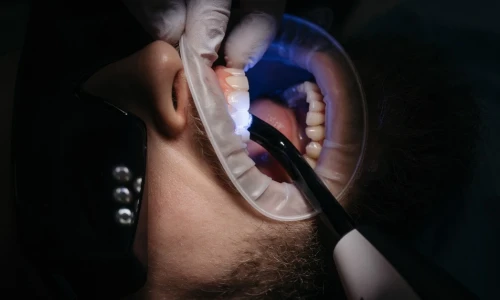 ¿Qué es un empaste dental y para qué sirve?