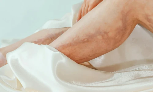 ¿Qué son las úlceras por várices?