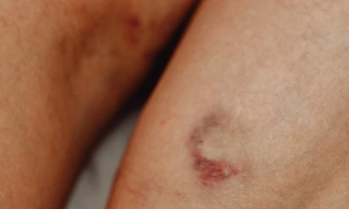 Riesgos de una úlcera en las piernas