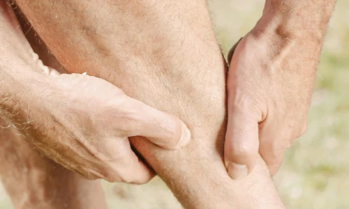 ¿Las várices son solo de mujeres?