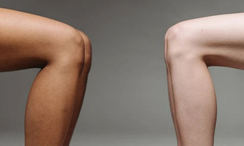 ¿Las várices solo aparecen en las piernas?