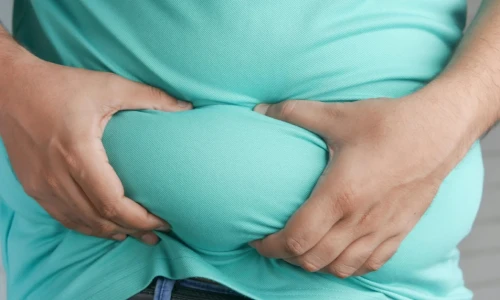 ¿El sobrepeso empeora las várices?