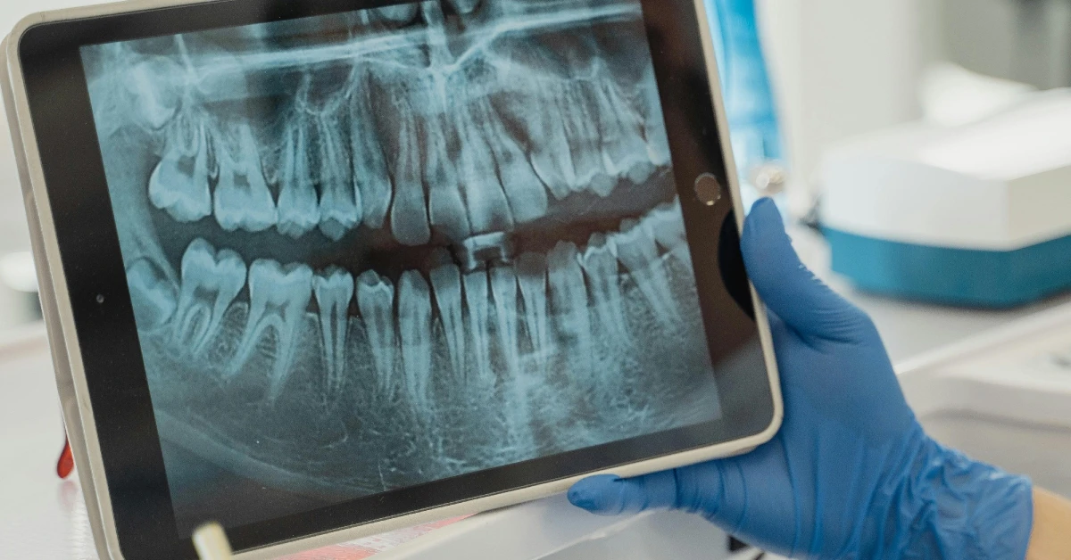 ¿Cuándo hacer rayos X en odontología?