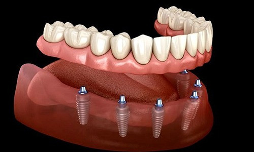 Implantes dentales: ¿valen la pena?